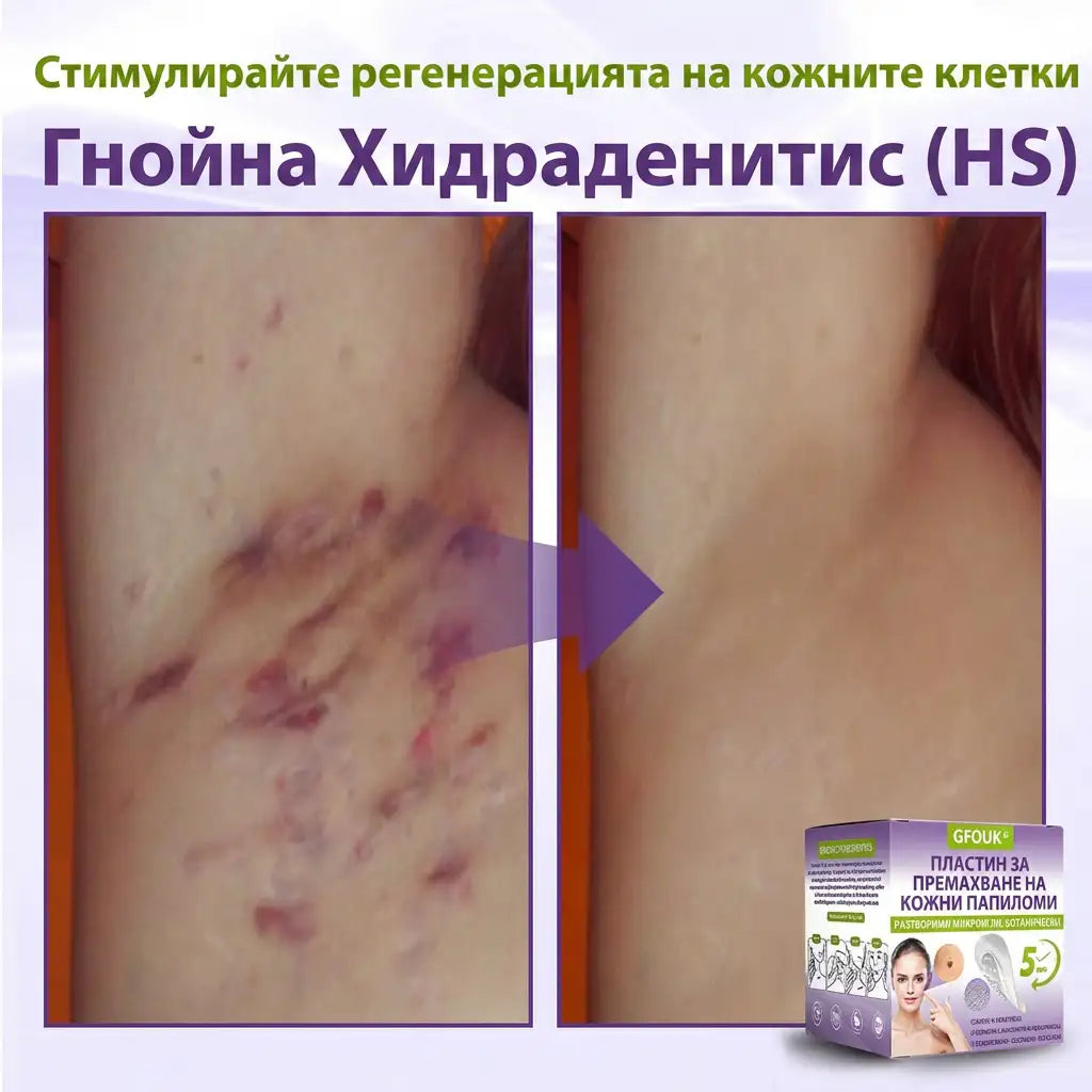 ✨ GFOUK® Разтворим ботанически пластир с микроигли за премахване на кожни образувания 🌴🌴