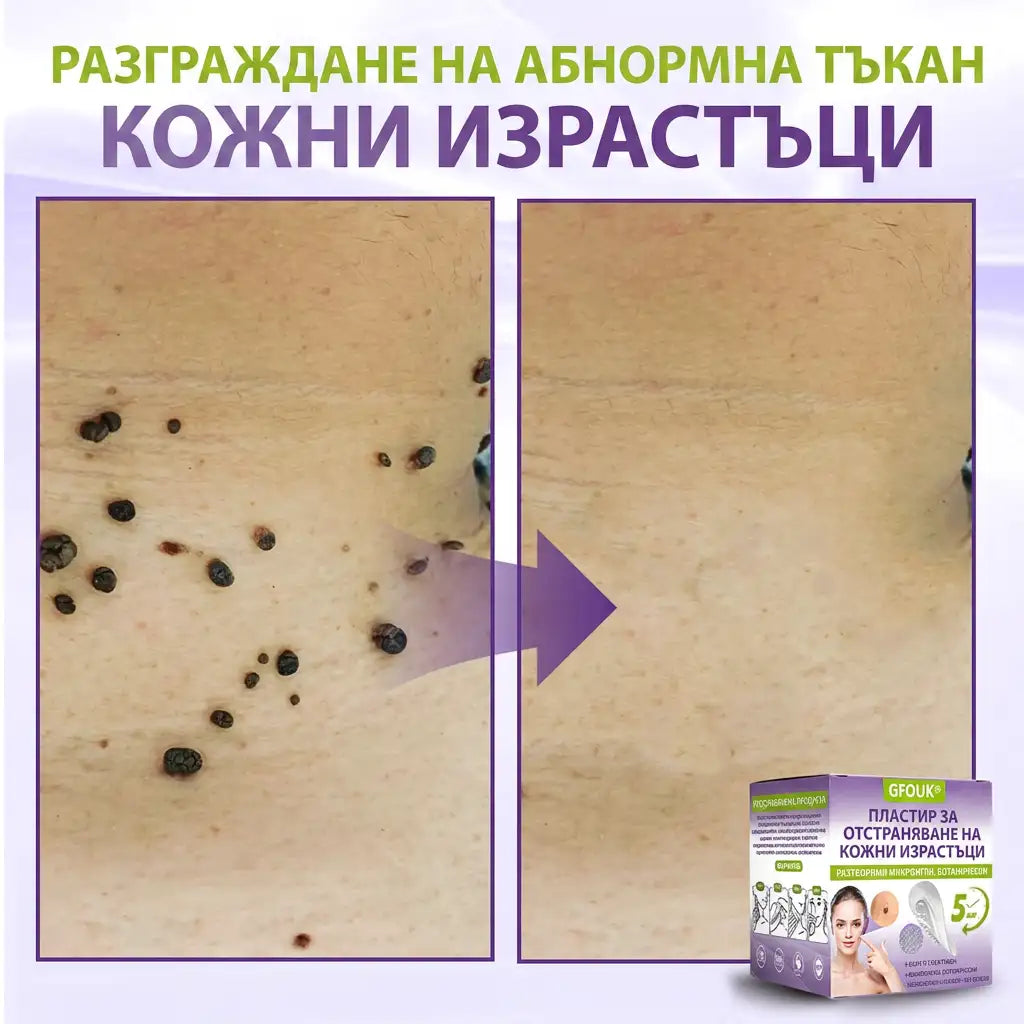 ✨ GFOUK® Разтворим ботанически пластир с микроигли за премахване на кожни образувания 🌴🌴