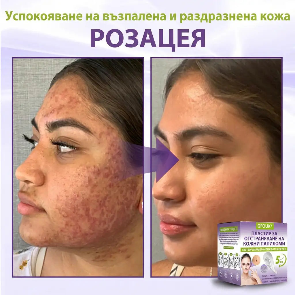 ✨ GFOUK® Разтворим ботанически пластир с микроигли за премахване на кожни образувания 🌴🌴