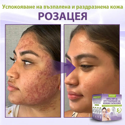 ✨ GFOUK® Разтворим ботанически пластир с микроигли за премахване на кожни образувания 🌴🌴
