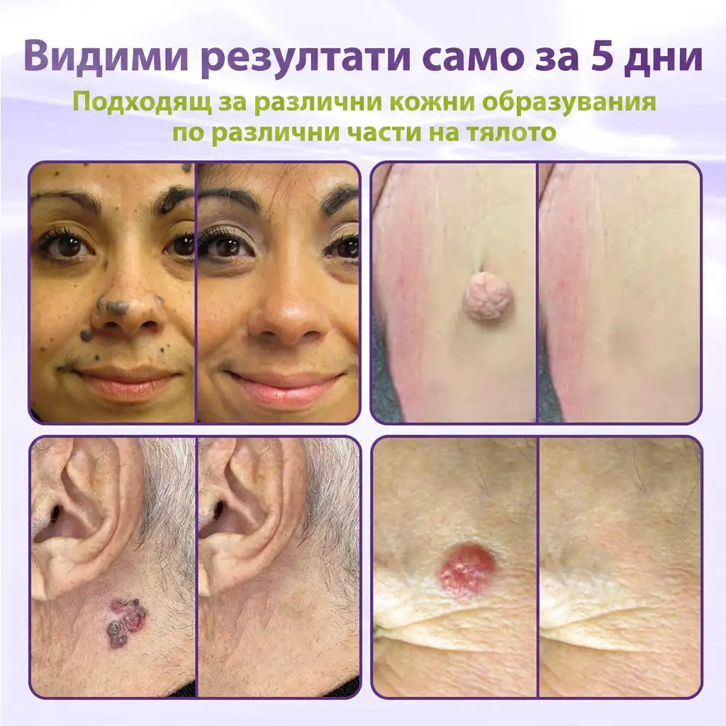 ✨ GFOUK® Разтворим ботанически пластир с микроигли за премахване на кожни образувания 🌴🌴