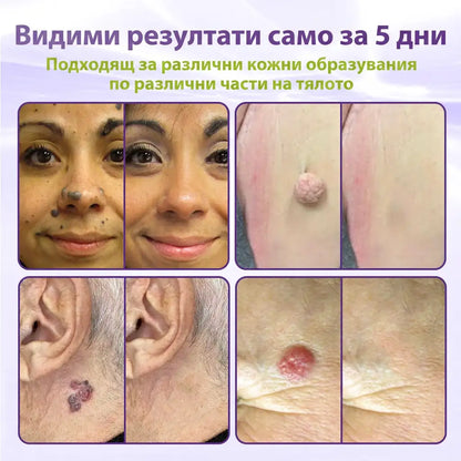 ✨ GFOUK® Разтворим ботанически пластир с микроигли за премахване на кожни образувания 🌴🌴