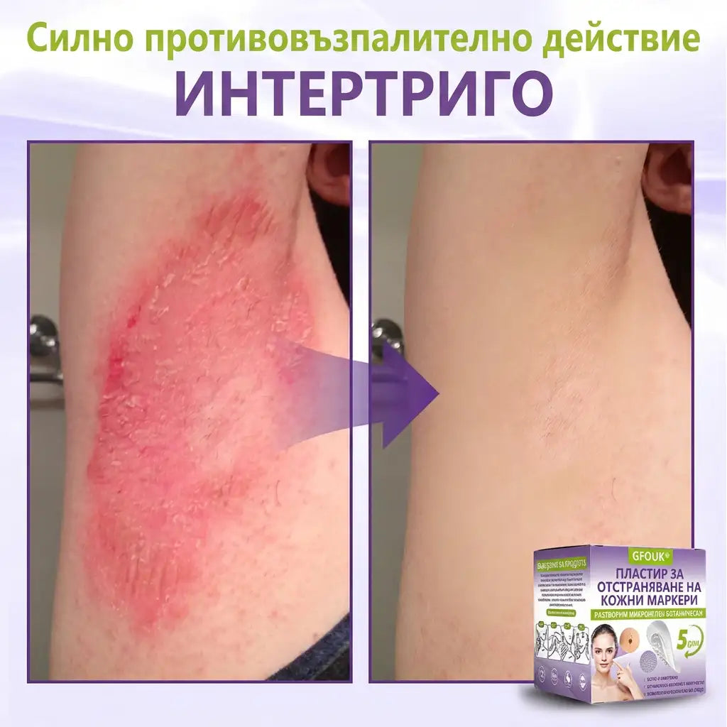 ✨ GFOUK® Разтворим ботанически пластир с микроигли за премахване на кожни образувания 🌴🌴
