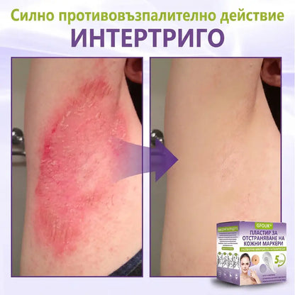 ✨ GFOUK® Разтворим ботанически пластир с микроигли за премахване на кожни образувания 🌴🌴