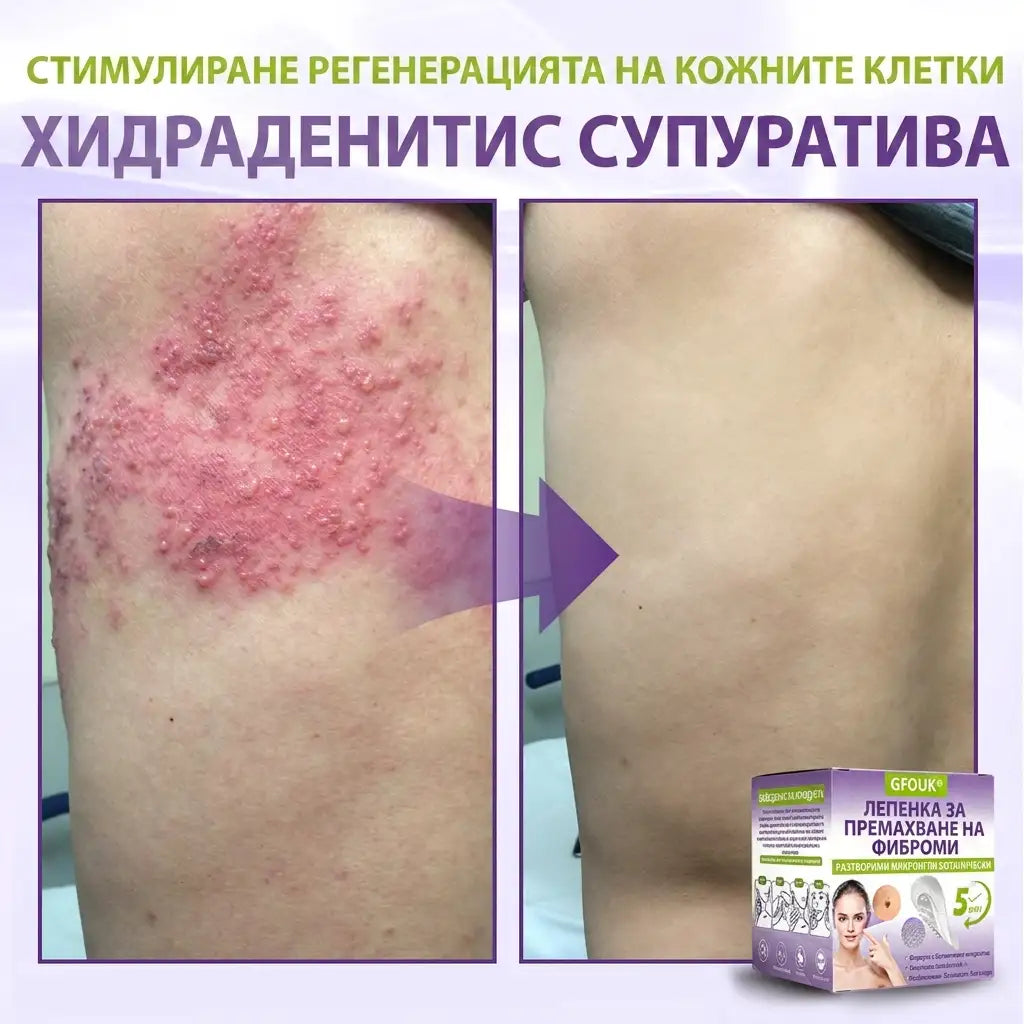 ✨ GFOUK® Разтворим ботанически пластир с микроигли за премахване на кожни образувания 🌴🌴