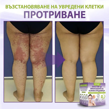 ✨ GFOUK® Разтворим ботанически пластир с микроигли за премахване на кожни образувания 🌴🌴