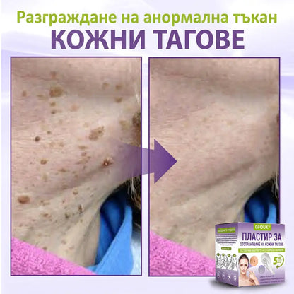 ✨ GFOUK® Разтворим ботанически пластир с микроигли за премахване на кожни образувания 🌴🌴