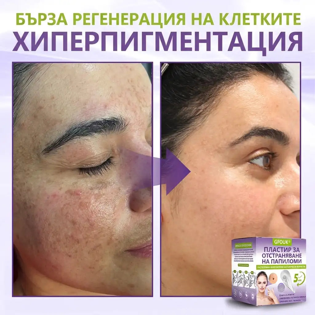 ✨ GFOUK® Разтворим ботанически пластир с микроигли за премахване на кожни образувания 🌴🌴